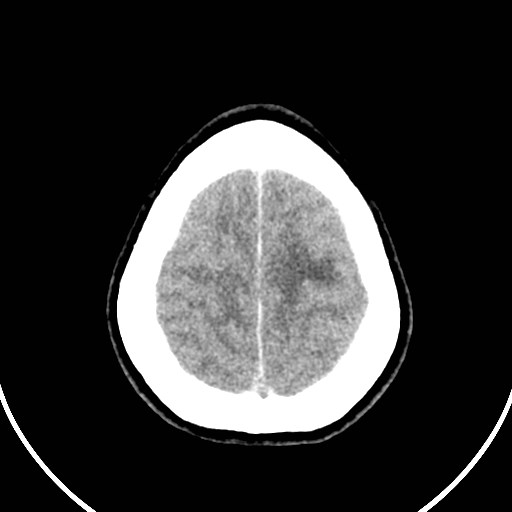 Central neurocytoma (Radiopaedia 84497-99871 Axial non-contrast 46).jpg