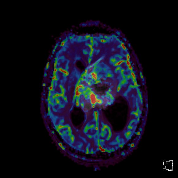 Central neurocytoma (Radiopaedia 84497-99872 Axial Perfusion 145).jpg