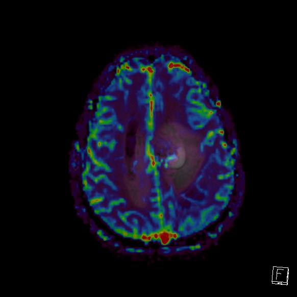 Central neurocytoma (Radiopaedia 84497-99872 Axial Perfusion 82).jpg