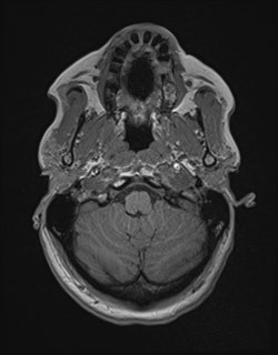 Central neurocytoma (Radiopaedia 84497-99872 Axial T1 38).jpg