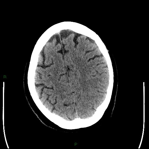 File:Cerebellar abscess (Radiopaedia 78135-90671 Axial non-contrast 83).jpg