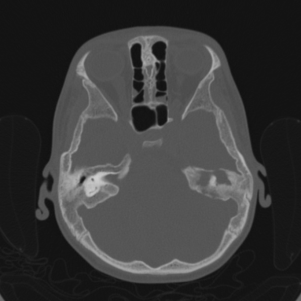 Cerebellar abscess secondary to mastoiditis (Radiopaedia 26284-26413 Axial bone window 62).jpg