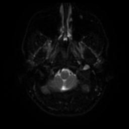 Cerebellar hemangioblastoma (Radiopaedia 29570-30077 Axial DWI 30).jpg
