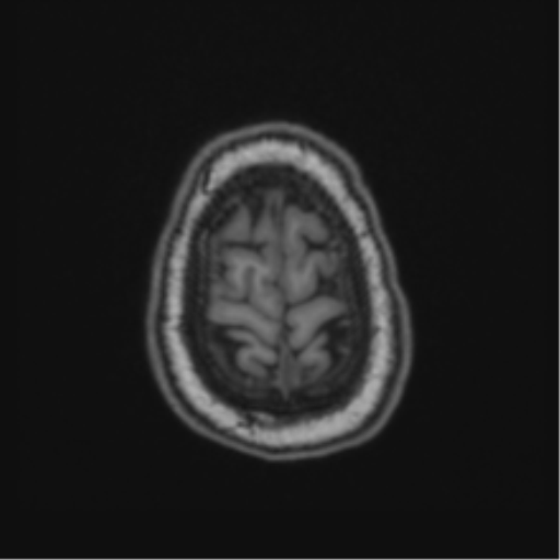 Cerebellar hemangioblastomas and pituitary adenoma (Radiopaedia 85490-101176 Axial T1 66).png