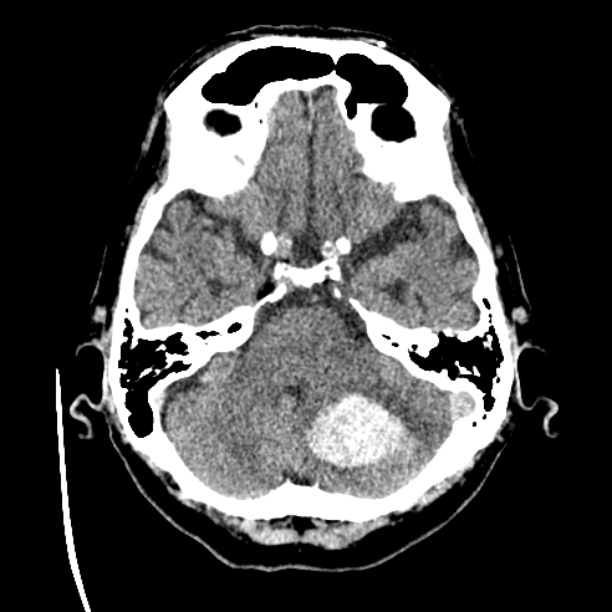 Cerebellar hemorrhage (Radiopaedia 27193-27359 Axial non-contrast 12).jpg