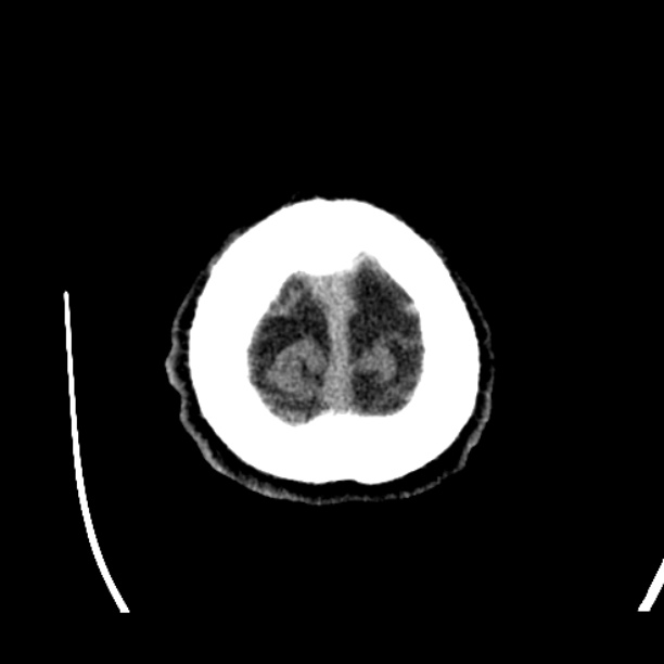Cerebellar hemorrhage (Radiopaedia 27193-27359 Axial non-contrast 53).jpg