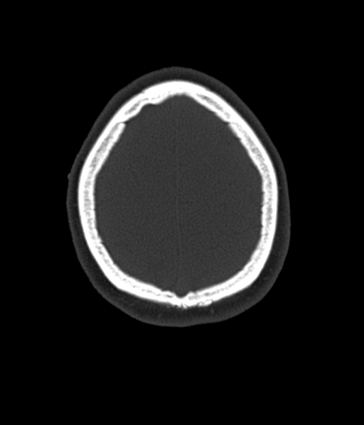 Cerebellar metastases - colorectal adenocarcinoma (Radiopaedia 40947-43652 AX Bone C- 2.0 MPR 56).png