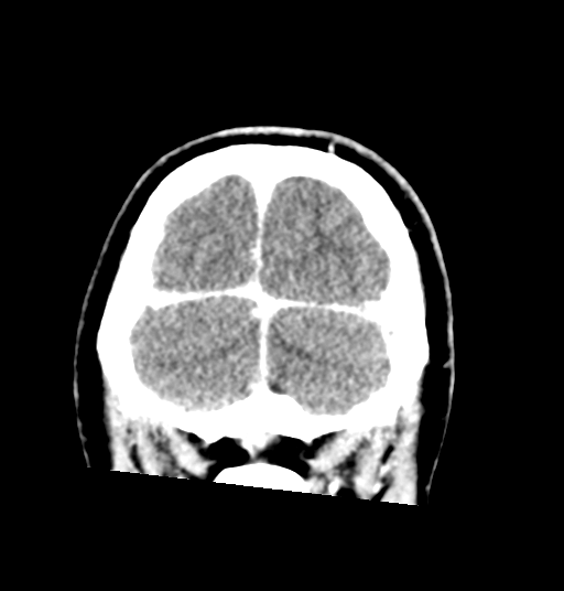 Cerebellar metastases - colorectal adenocarcinoma (Radiopaedia 40947-43652 Coronal C+ 81).png