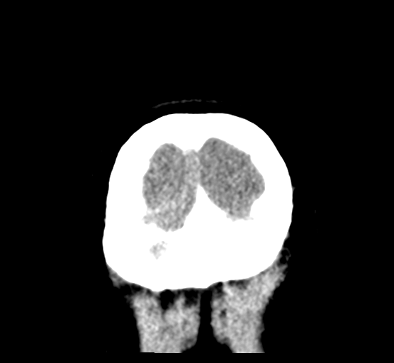 Cerebellar metastases - colorectal adenocarcinoma (Radiopaedia 40947-43652 Coronal non-contrast 88).png