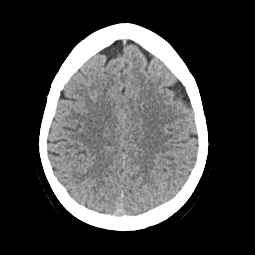 Cerebellar metastasis (Radiopaedia 54578-60812 Axial non-contrast 36).png