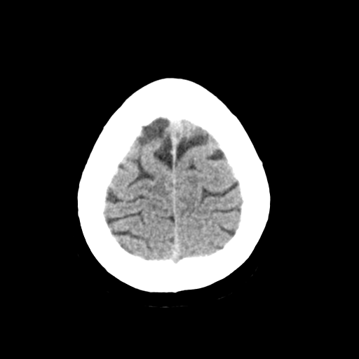 Cerebellar metastasis (Radiopaedia 54578-60812 Axial non-contrast 44).png