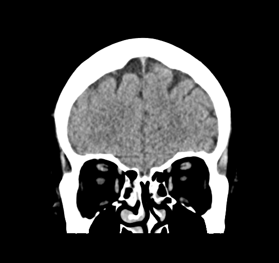 Cerebellar metastasis (Radiopaedia 54578-60812 Coronal non-contrast 11).png