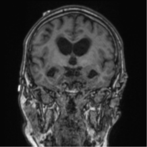 Cerebellar metastasis from lung adenocarcinoma (Radiopaedia 86690-102829 Coronal T1 57).png