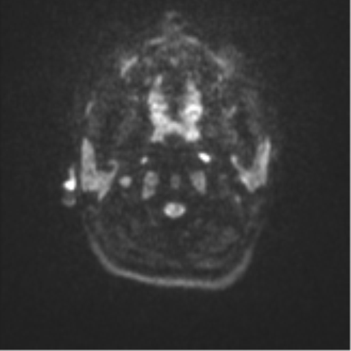 Cerebellar tuberculomas (Radiopaedia 46939-51472 Axial DWI 29).png
