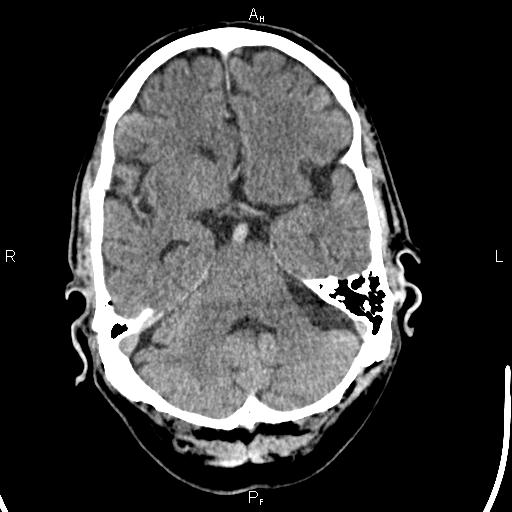 Cerebellopontine angle arachnoid cyst (Radiopaedia 85149-100704 Axial With contrast 14).jpg