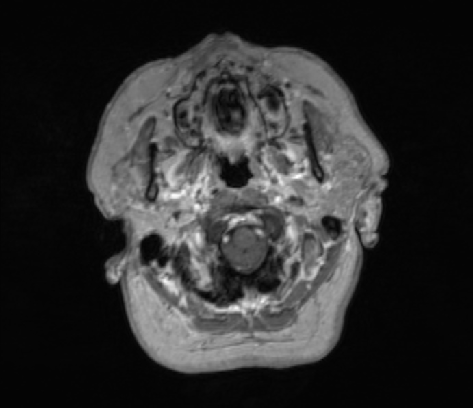 Cerebellopontine angle meningioma (Radiopaedia 35181-36715 Axial T1 C+ 50).jpg