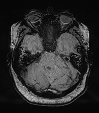 Cerebellopontine angle meningioma (Radiopaedia 48434-53348 Axial SWI 28).png