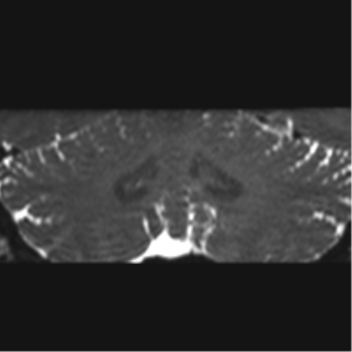 Cerebellopontine angle meningioma (Radiopaedia 48434-53348 Coronal T2 16).png