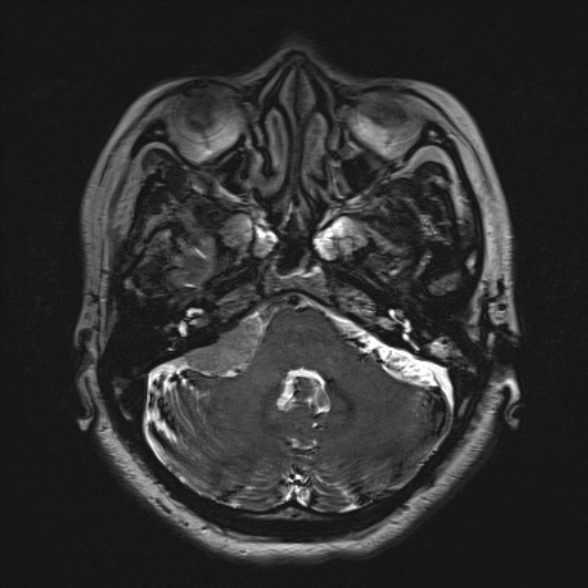 Cerebellopontine angle meningioma (Radiopaedia 53561-59591 Axial 3D volume T2 53).jpg