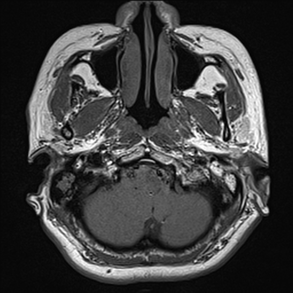 File:Cerebellopontine angle meningioma (Radiopaedia 53561-59591 Axial T1 2).jpg