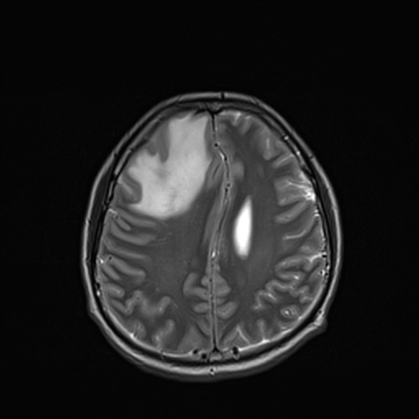 Cerebral abscess (Radiopaedia 24212-24478 Axial T2 43).jpg