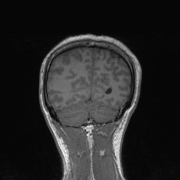 Cerebral abscess (Radiopaedia 24212-24478 Coronal T1 165).jpg