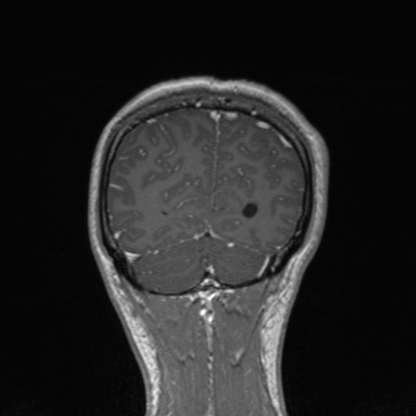 Cerebral abscess (Radiopaedia 24212-24478 Coronal T1 C+ 168).jpg