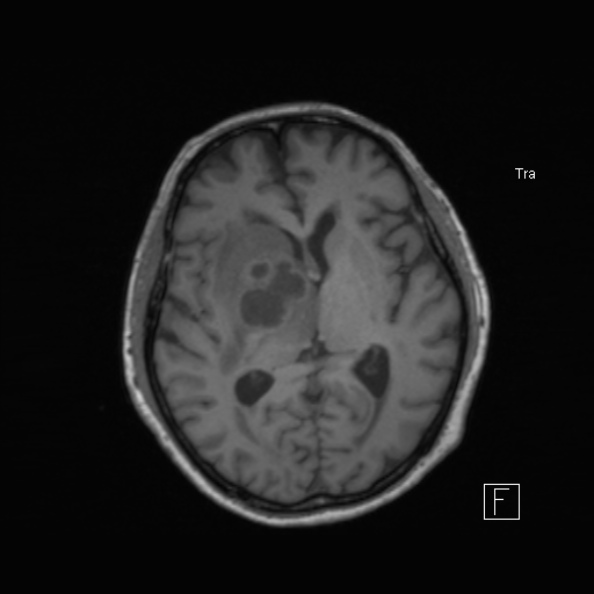 Cerebral abscess (Radiopaedia 26111-26247 Axial T1 34).jpg