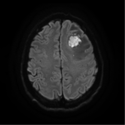 File:Cerebral abscess (Radiopaedia 57774-64740 Axial DWI 22).png