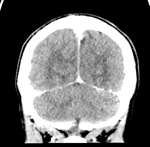 File:Cerebral abscess (Radiopaedia 60342-68008 Coronal C+ delayed 53).png