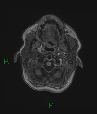 Cerebral abscess and subdural empyema (Radiopaedia 84436-99779 Axial T1 81).jpg