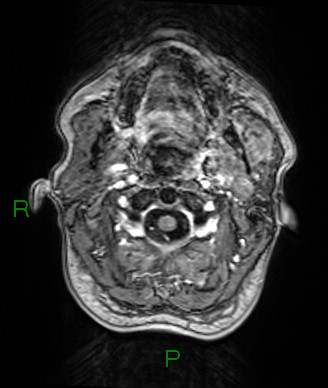 Cerebral abscess and subdural empyema (Radiopaedia 84436-99779 Axial T1 C+ 84).jpg