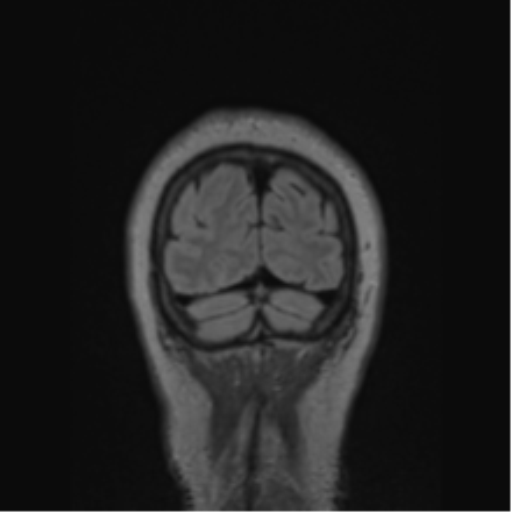 Cerebral abscess from pulmonary arteriovenous malformation (Radiopaedia 86275-102291 Coronal FLAIR 13).png