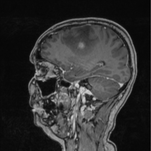 Cerebral abscess from pulmonary arteriovenous malformation (Radiopaedia 86275-102291 Sagittal T1 C+ 51).png