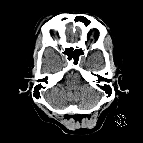 Cerebral abscess with ventriculitis (Radiopaedia 78965-91876 Axial non-contrast 13).jpg