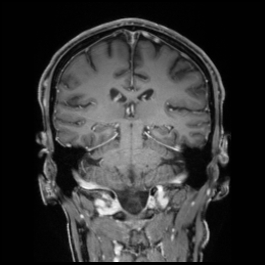Cerebral abscess with ventriculitis (Radiopaedia 78965-91878 Coronal T1 C+ 39).jpg