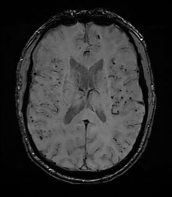 Cerebral amyloid angiopathy (Radiopaedia 46082-50433 Axial SWI 48).png