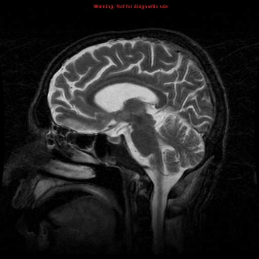 File:Cerebral and orbital tuberculomas (Radiopaedia 13308-13311 Sagittal T2 9).jpg
