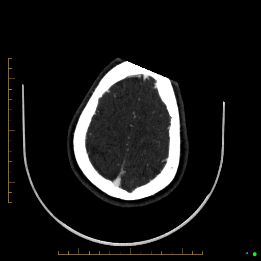 Cerebral arteriovenous malformation (AVM) (Radiopaedia 78162-90706 Axial CTA 234).jpg