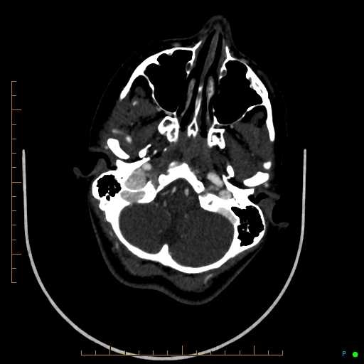 Cerebral arteriovenous malformation (AVM) (Radiopaedia 78162-90706 Axial CTA 60).jpg