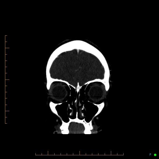 Cerebral arteriovenous malformation (AVM) (Radiopaedia 78162-90706 Coronal CTA 86).jpg