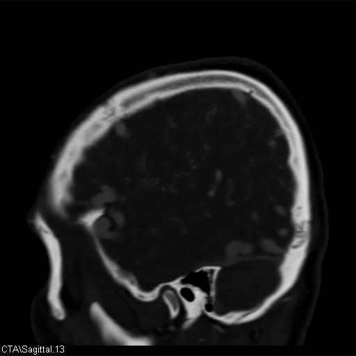 Cerebral arteriovenous malformation (Radiopaedia 28518-28759 D 10).jpg
