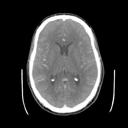 Cerebral arteriovenous malformation (Radiopaedia 55798-62371 B 27).png