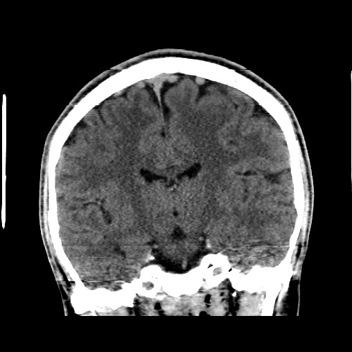 Cerebral arteriovenous malformation (Radiopaedia 61964-70028 Coronal non-contrast 32).jpg