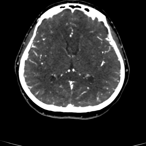 Cerebral arteriovenous malformation (Radiopaedia 73830-84645 Axial C+ delayed 44).jpg
