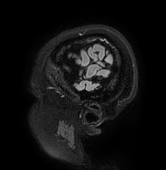 Cerebral arteriovenous malformation (Radiopaedia 74411-85654 Sagittal FLAIR 6).jpg