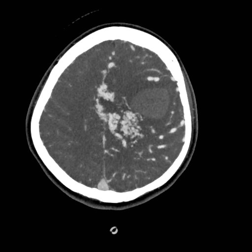 File:Cerebral arteriovenous malformation (Radiopaedia 79677-92888 A 43).jpg