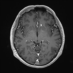 Cerebral arteriovenous malformation (Radiopaedia 84015-99245 Axial T1 C+ 74).jpg