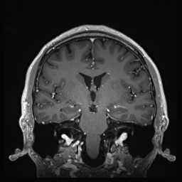 Cerebral arteriovenous malformation (Radiopaedia 84015-99245 Coronal T1 C+ 81).jpg