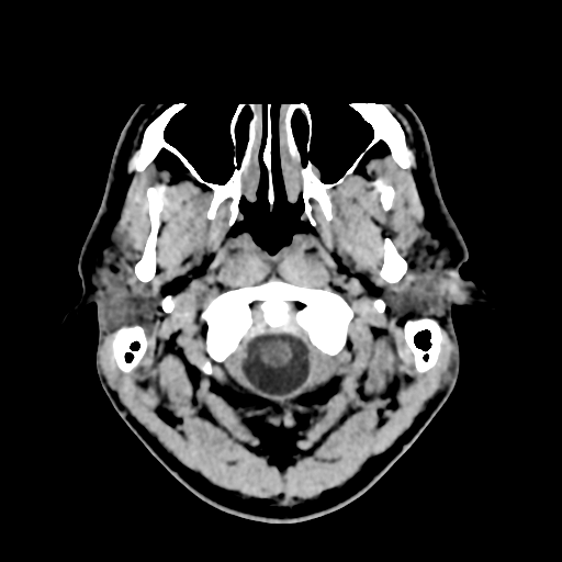 Cerebral arteriovenous malformation (Spetzler-Martin grade 2) (Radiopaedia 41262-44076 Axial non-contrast 5).png